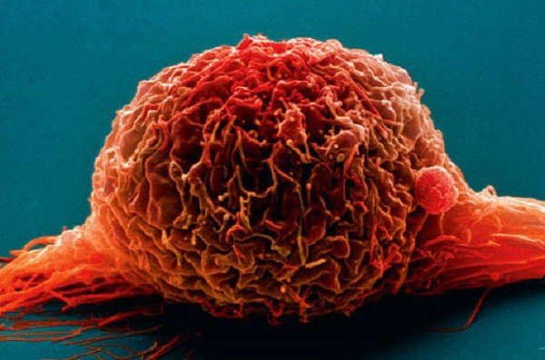 Выбрать метод лечения рака мочевого пузыря поможет математика