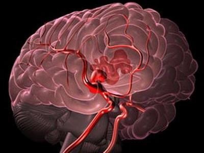 Механики и математики помогают снизить смертность от кровоизлияний в мозг