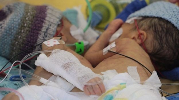 Швейцарские хирурги разделили восьмидневных сиамских близнецов