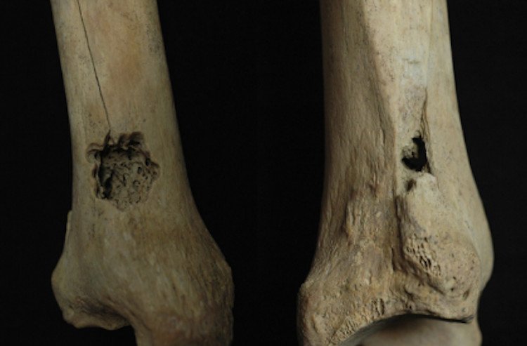 Древние перуанцы трепанировали не только черепа