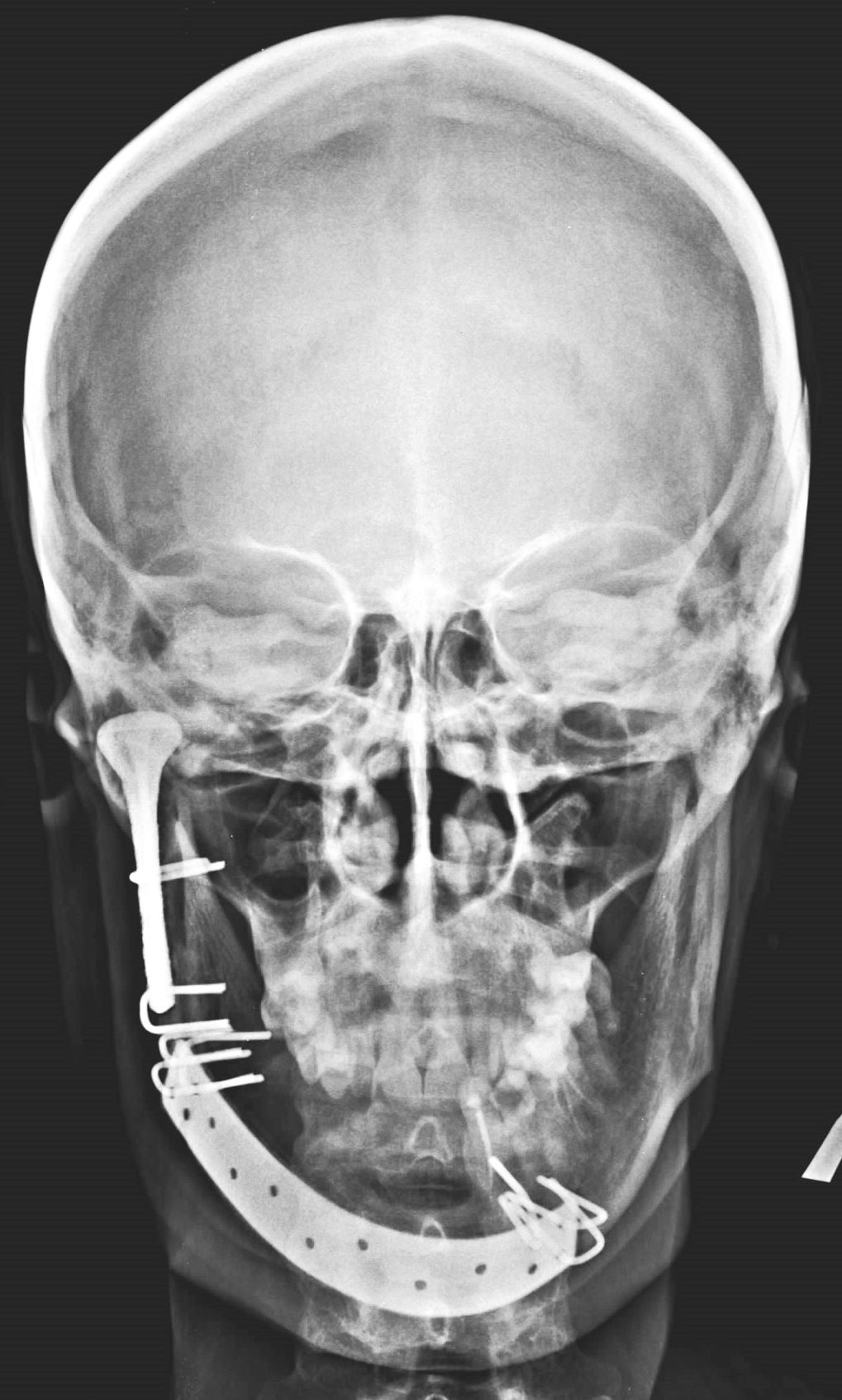 На снимке -  рентгенограмма больной после замещения тела и правой ветви нижней челюсти по поводу амелобластомы и деструктивных изменений правой нижнечелюстной головки 