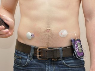 Искусственная поджелудочная железа работает уже три месяца