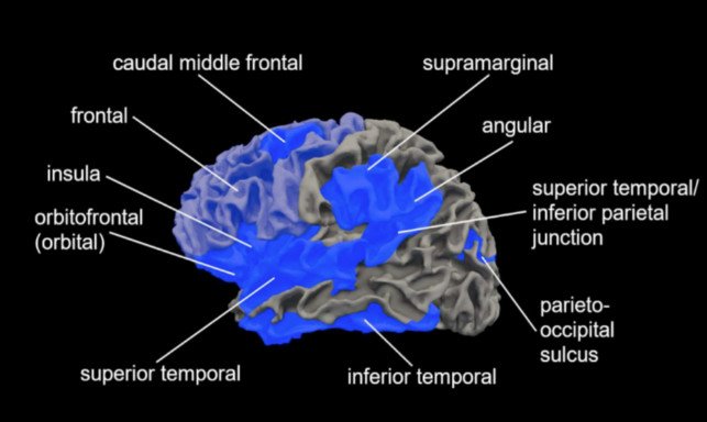 Левое полушарие головного мозга. Синим цветом обозначены области, где была обнаружена гипогирификация у пациентов с шизофренией по сравнению с контрольной группой (по данным проведенного учеными метаанализа научных работ)