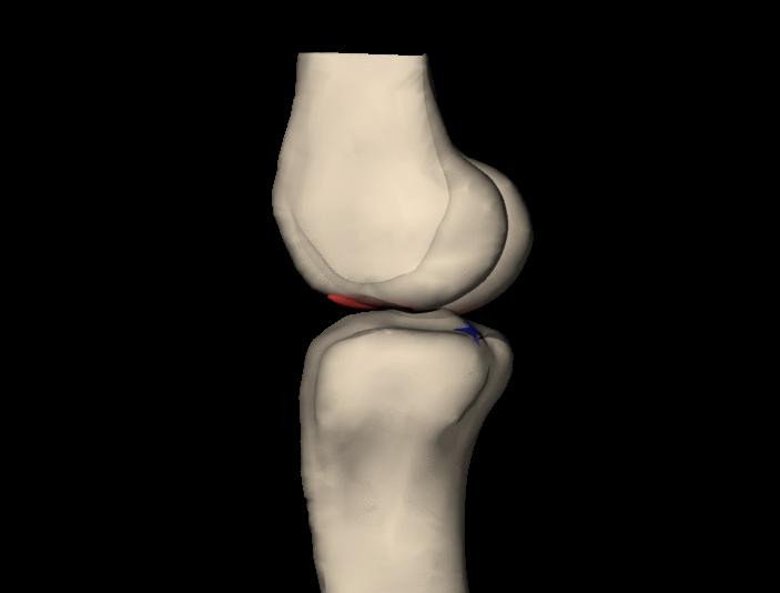Мужчины и женщины разрывают крестообразную связку колена одинаковым способом