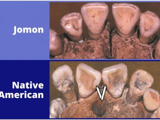 Визуальное различие зубного ряда, типичного, соответственно, для представителей населения дзёмон, и коренного населения Америки