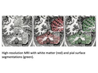 Новый метод визуализации позволил подробнее рассмотреть мозжечок