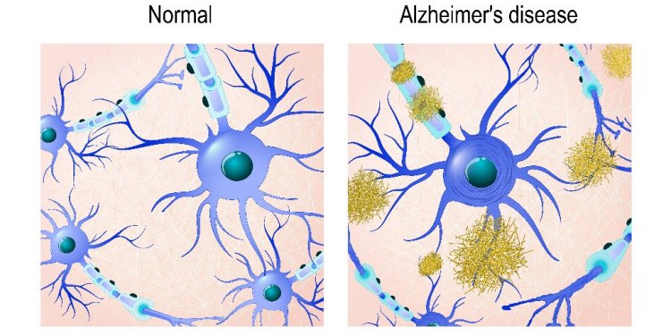 Очередной прорыв в исследовании болезни Альцгеймера