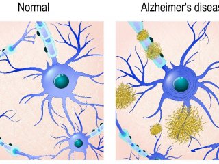 Очередной прорыв в исследовании болезни Альцгеймера