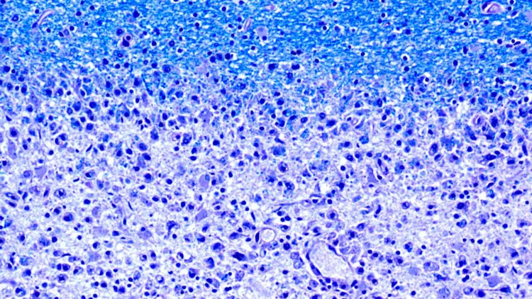 Обнаружена связь между микрофлорой кишечника и рассеянным склерозом