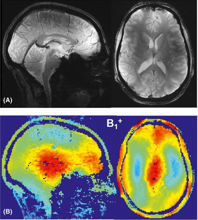 Изображение головного мозга волонтера и распределение радиочастотного магнитного поля, полученные с помощью разработанной фазированной решетки.
