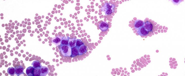 Ученые превратили раковые клетки крови в иммунные