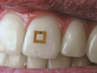 Крошечный сенсор на зубе поможет следить за здоровьем