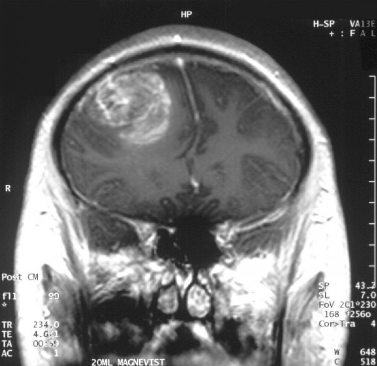 Снимок МРТ с глиобластомой у анонимного 15-летнего мальчика. Автор: A. Christaras, источник: Wikipedia