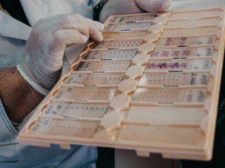 Окрашенные гистологические срезы ткани для выявления раковых клеток. Фото Анастасии Тамаровской / ФИЦ КНЦ СО РАН