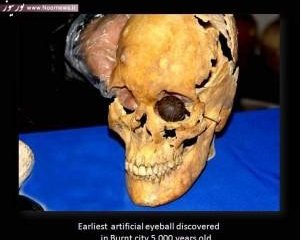 В Иране найден первый в мире искусственный глаз