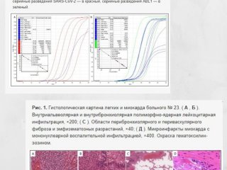 Российскими учеными описан механизм распространения  COVID-19 из легких в другие органы