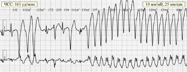 Нарушения ритма у пациента с аритмогеннной кардиомиопатией правого желудочка с высоким риском внезапной сердечной смерти