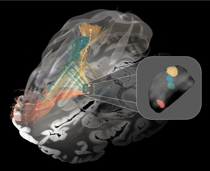 Пораженные мозговые цепи при болезни Паркинсона (зеленый), дистонии (желтый), синдроме Туретта (синий) и обсессивно-компульсивном расстройстве (красный). Вставка: оптимальные целевые области для глубокой стимуляции мозга в базальных ганглиях