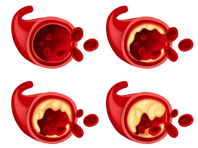Обнаружена реакция организма, защищающая от атеросклероза. Фото: brgfx / Magnific.com