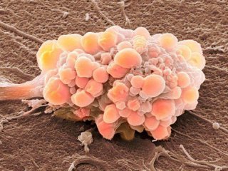 На слабые места раковой опухоли могут указать белки-мутанты