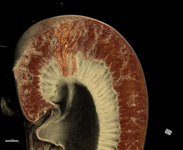 Трехмерное изображение зоны инфаркта почки, полученное методом компьютерной томографии. Источник: Петр Тимашев