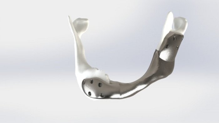 Ученые успешно имплантировали нижнюю титановую челюсть, напечатанную на 3D-принтере  