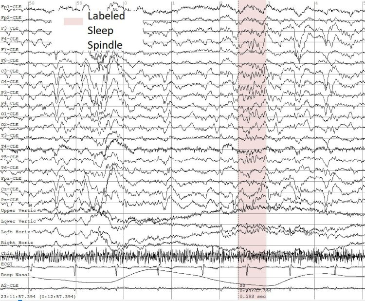 Пример паттернов сна (сонных веретен) в записях ЭЭГ. Иллюстрация предоставлена пресс-службой ННГУ