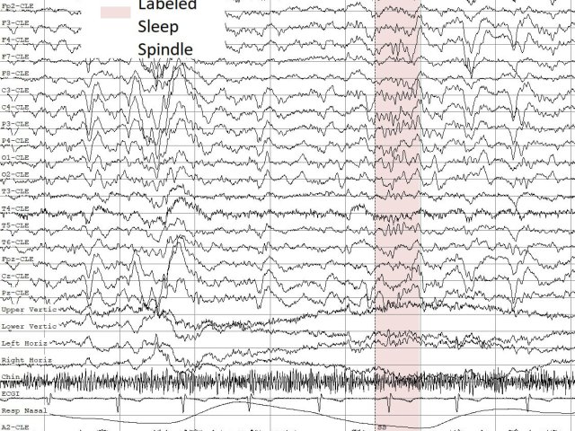 Пример паттернов сна (сонных веретен) в записях ЭЭГ. Иллюстрация предоставлена пресс-службой ННГУ