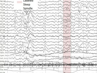 Пример паттернов сна (сонных веретен) в записях ЭЭГ. Иллюстрация предоставлена пресс-службой ННГУ