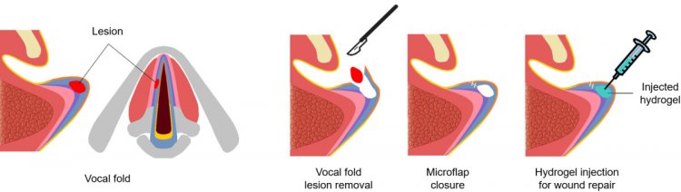 Пример того, как используется инъекционный гидрогель в качестве имплантата для заполнения поврежденного участка голосовых связок и восстановления голоса.