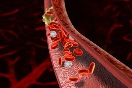 Создана компьютерная модель роста тромбов в артериях