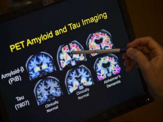 Новые способы определения болезни Альцгеймера на ранней стадии