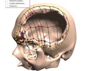 Студент НГТУ изобрел первую в России технологию создания индивидуальных имплантов для людей с черепно-мозговыми травмами