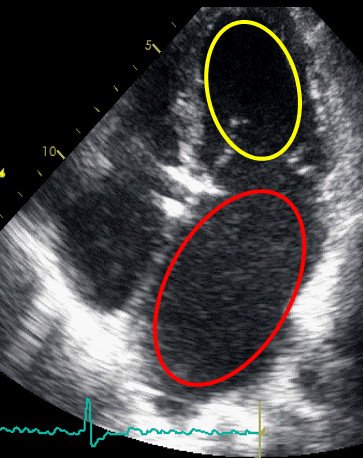 Эхокардиография (УЗИ сердца) пациента с рестриктивной кардиомиопатией значительно увеличено левое предсердие (красный цвет) при нормальных размерах левого желудочка (желтый цвет). Предоставлено Ю.Л. Лутохиной