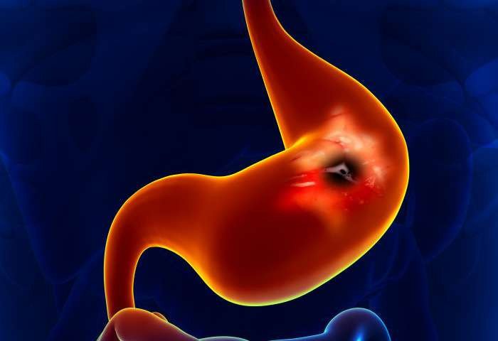 Британские ученые разработали тест на дыхание для ранней диагностики рака пищевода и желудка