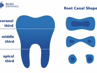 Стоматологи составили новую классификацию изменения формы зубного канала