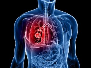 Рак легких теперь можно диагностировать по выдыхаемому воздуху