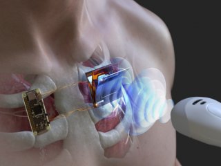 Корейские ученые разработали беспроводную зарядку для электронных имплантатов 