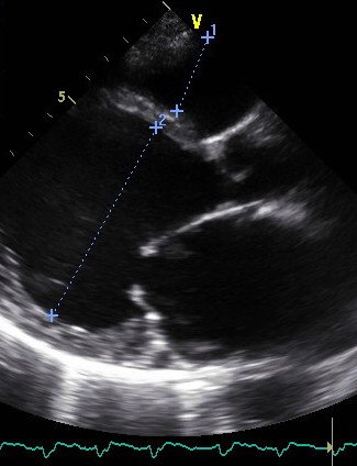 Расширение камер сердца при эхокардиографии (УЗИ сердца) у пациентки с дилатационной кардиомиопатией. Предоставлено Ю.Л. Лутохиной