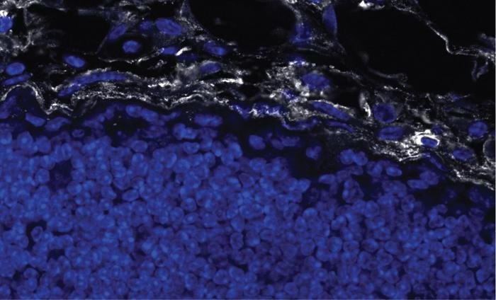 На этой микрофотографии фиброзный коллаген (белый) инкапсулирует опухоль молочной железы. Клетки с ядрами окрашены в синий цвет. Фото: Kevin Tharp, Sanford Burnham Prebys