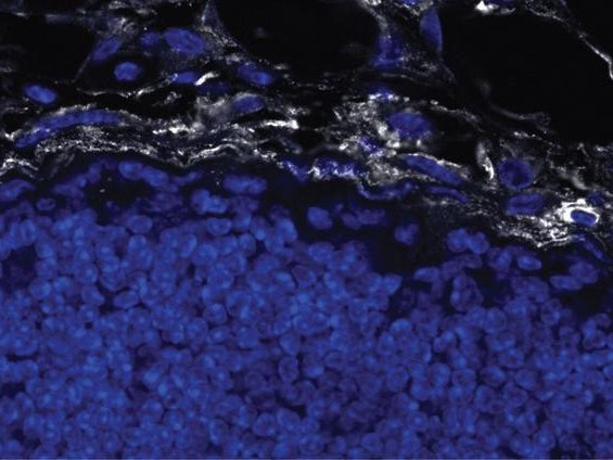 На этой микрофотографии фиброзный коллаген (белый) инкапсулирует опухоль молочной железы. Клетки с ядрами окрашены в синий цвет. Фото: Kevin Tharp, Sanford Burnham Prebys