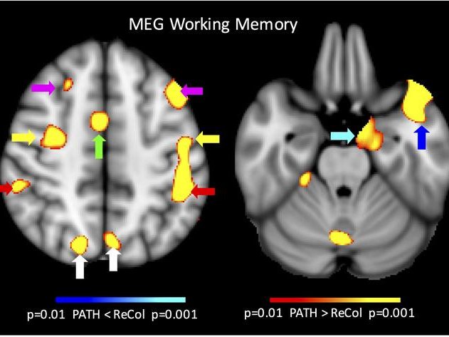 Исследование показало, что новый подход под названием «Терапия перцептивного внимания» (PATH) восстанавливает внимание, память и навыки чтения эффективнее, чем стандартные методы лечения.Фото: MEG Center at UC San Diego Qualcomm Institute