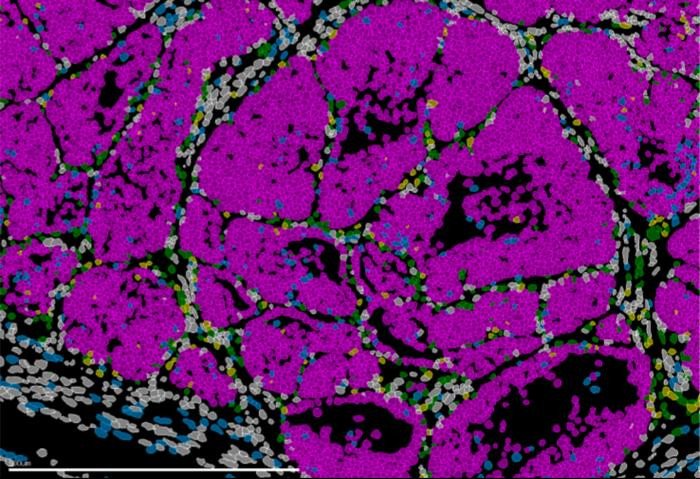 Изображение опухоли молочной железы мыши, на котором видны отдельные клеточные популяции (раковые клетки выделены розовым). Фото: Instituto de Neurociencias UMH CSIC / Ángela Nieto
