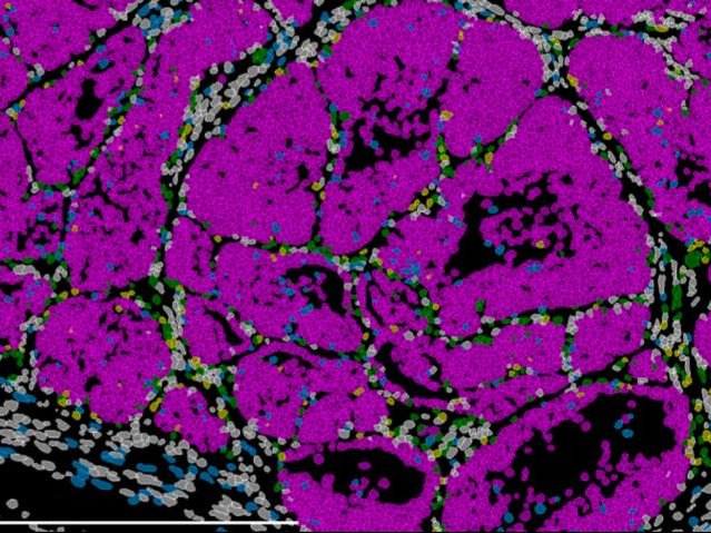 Изображение опухоли молочной железы мыши, на котором видны отдельные клеточные популяции (раковые клетки выделены розовым). Фото: Instituto de Neurociencias UMH CSIC / Ángela Nieto
