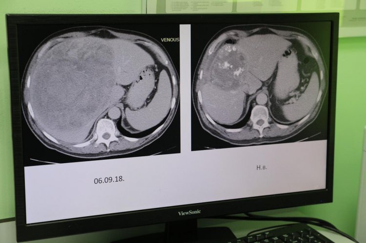 На изображении слева — опухоль до применения радиоэмболизации. Справа — результат метода: опухоль побеждена
