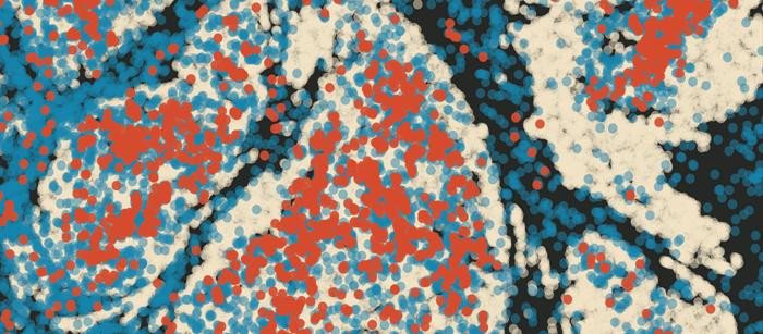 Светло-серым цветом обозначены опухолевые клетки. Среди инфильтрирующих нейтрофилов есть те, которые не экспрессируют CCL3 (синие), и те, которые экспрессируют CCL3 (красные). Фото: © Mikaël Pittet – UNIGE