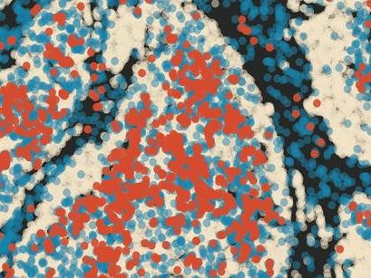 Светло-серым цветом обозначены опухолевые клетки. Среди инфильтрирующих нейтрофилов есть те, которые не экспрессируют CCL3 (синие), и те, которые экспрессируют CCL3 (красные). Фото: © Mikaël Pittet – UNIGE