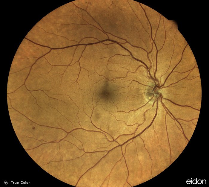 Нейросеть научилась определять заболевание артерий по снимкам глаза