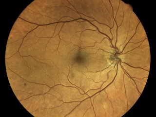 Нейросеть научилась определять заболевание артерий по снимкам глаза