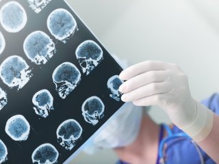 Болезнь Альцгеймера и шизофрения связаны с одной областью мозга